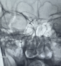 动脉长鞘怎么置入有励可说｜Locaste 088励楷长鞘及Tarvos微导丝在右侧大脑中动脉M2段取栓术中的应用_https://www.jmylbn.com_新闻资讯_第16张