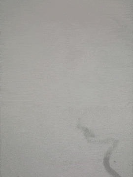 动脉长鞘怎么置入术说·第十七期丨Infinity长鞘助力Surpass Streamline血流导向密网支架治疗双侧颈内迂曲路径动脉瘤一例_https://www.jmylbn.com_新闻资讯_第30张