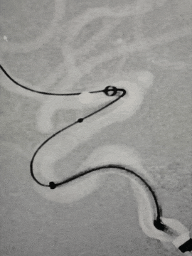 动脉长鞘怎么置入术说·第十七期丨Infinity长鞘助力Surpass Streamline血流导向密网支架治疗双侧颈内迂曲路径动脉瘤一例_https://www.jmylbn.com_新闻资讯_第18张