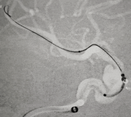 动脉长鞘怎么置入术说·第十七期丨Infinity长鞘助力Surpass Streamline血流导向密网支架治疗双侧颈内迂曲路径动脉瘤一例_https://www.jmylbn.com_新闻资讯_第27张