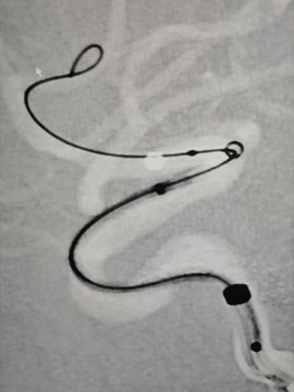 动脉长鞘怎么置入术说·第十七期丨Infinity长鞘助力Surpass Streamline血流导向密网支架治疗双侧颈内迂曲路径动脉瘤一例_https://www.jmylbn.com_新闻资讯_第20张