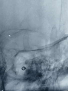 动脉长鞘怎么置入术说·第十七期丨Infinity长鞘助力Surpass Streamline血流导向密网支架治疗双侧颈内迂曲路径动脉瘤一例_https://www.jmylbn.com_新闻资讯_第31张