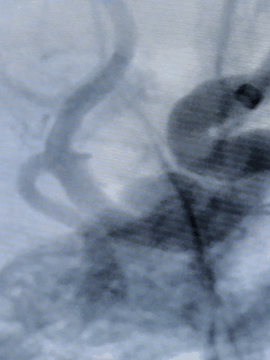 动脉长鞘怎么置入术说·第十七期丨Infinity长鞘助力Surpass Streamline血流导向密网支架治疗双侧颈内迂曲路径动脉瘤一例_https://www.jmylbn.com_新闻资讯_第29张