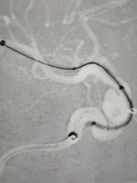 动脉长鞘怎么置入术说·第十七期丨Infinity长鞘助力Surpass Streamline血流导向密网支架治疗双侧颈内迂曲路径动脉瘤一例_https://www.jmylbn.com_新闻资讯_第26张