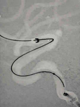 动脉长鞘怎么置入术说·第十七期丨Infinity长鞘助力Surpass Streamline血流导向密网支架治疗双侧颈内迂曲路径动脉瘤一例_https://www.jmylbn.com_新闻资讯_第16张