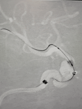 动脉长鞘怎么置入术说·第十七期丨Infinity长鞘助力Surpass Streamline血流导向密网支架治疗双侧颈内迂曲路径动脉瘤一例_https://www.jmylbn.com_新闻资讯_第28张