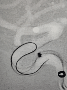 动脉长鞘怎么置入术说·第十七期丨Infinity长鞘助力Surpass Streamline血流导向密网支架治疗双侧颈内迂曲路径动脉瘤一例_https://www.jmylbn.com_新闻资讯_第21张