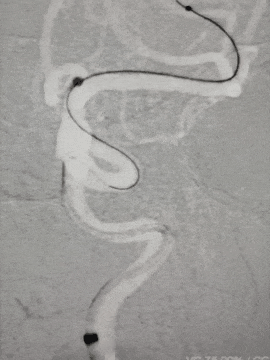 动脉长鞘怎么置入术说·第十七期丨Infinity长鞘助力Surpass Streamline血流导向密网支架治疗双侧颈内迂曲路径动脉瘤一例_https://www.jmylbn.com_新闻资讯_第23张