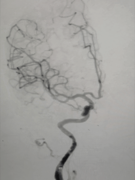 动脉长鞘怎么置入术说·第十七期丨Infinity长鞘助力Surpass Streamline血流导向密网支架治疗双侧颈内迂曲路径动脉瘤一例_https://www.jmylbn.com_新闻资讯_第8张