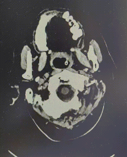 什么叫桡鞘畅疗·第十五期｜畅医达 5F 0.072