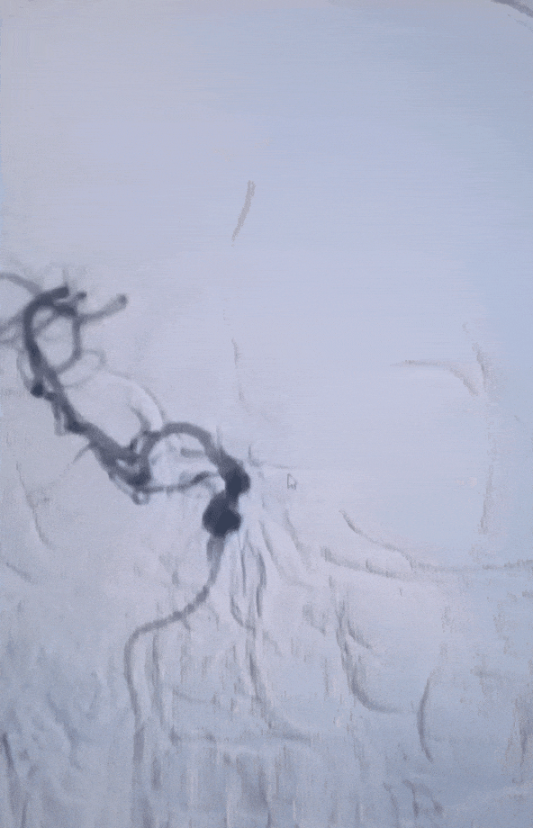 动脉长鞘怎么置入有励可说｜Locaste 088励楷长鞘在右侧颈内动脉闭塞并夹层术中的应用_https://www.jmylbn.com_新闻资讯_第11张