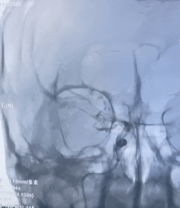 动脉长鞘怎么置入有励可说｜Locaste 088励楷长鞘在右侧颈内动脉闭塞并夹层术中的应用_https://www.jmylbn.com_新闻资讯_第9张