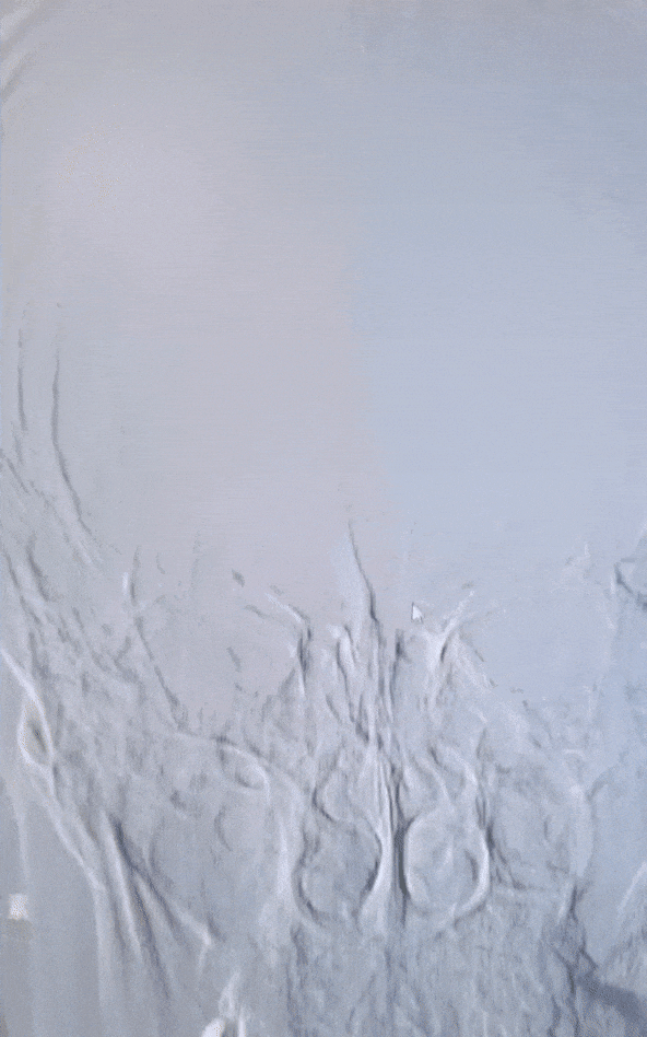 动脉长鞘怎么置入有励可说｜Locaste 088励楷长鞘在右侧颈内动脉闭塞并夹层术中的应用_https://www.jmylbn.com_新闻资讯_第7张