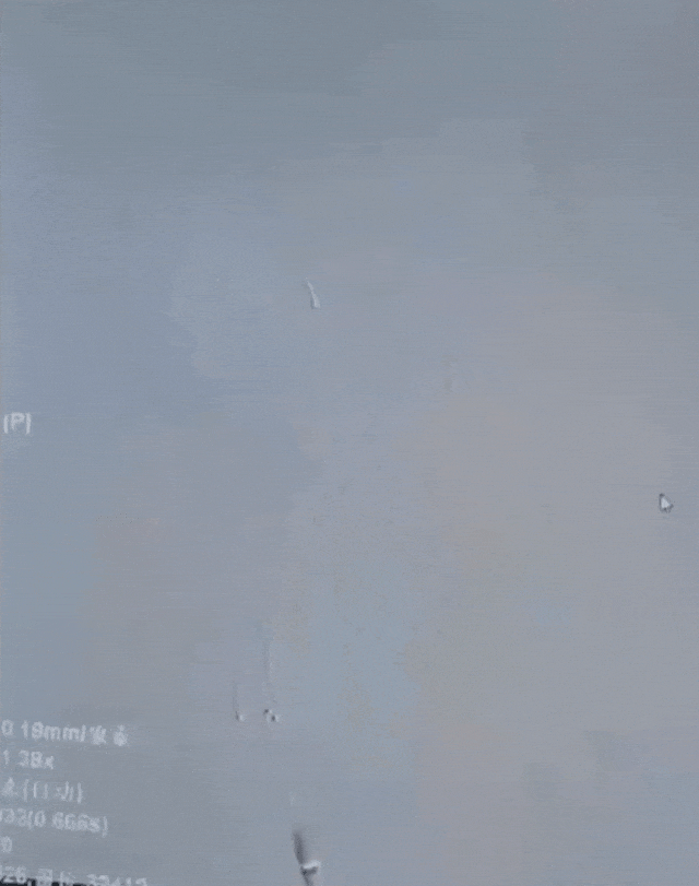 动脉长鞘怎么置入有励可说｜Locaste 088励楷长鞘在右侧颈内动脉闭塞并夹层术中的应用_https://www.jmylbn.com_新闻资讯_第14张