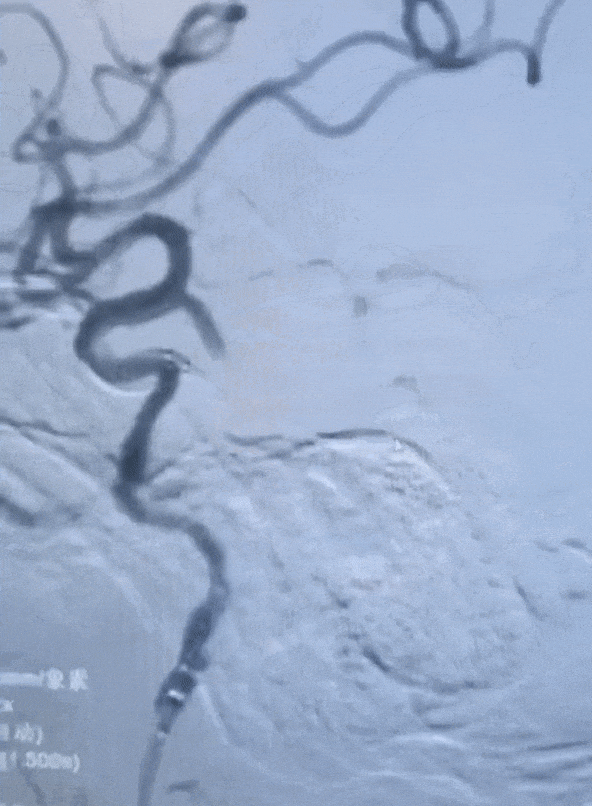 动脉长鞘怎么置入有励可说｜Locaste 088励楷长鞘在右侧颈内动脉闭塞并夹层术中的应用_https://www.jmylbn.com_新闻资讯_第12张