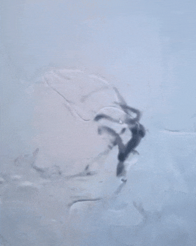 动脉长鞘怎么置入有励可说｜Locaste 088励楷长鞘在右侧颈内动脉闭塞并夹层术中的应用_https://www.jmylbn.com_新闻资讯_第10张