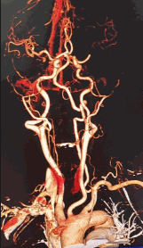 动脉长鞘怎么置入有励可说｜Locaste 088励楷长鞘及Tarvos微导丝在左侧大脑中动脉闭塞取栓术中的应用_https://www.jmylbn.com_新闻资讯_第4张