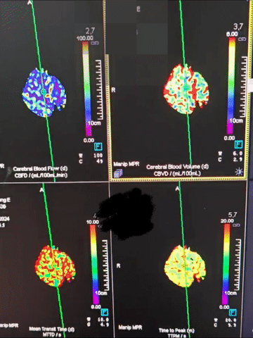 动脉长鞘怎么置入有励可说｜Locaste 088励楷长鞘及Tarvos微导丝在左侧大脑中动脉闭塞取栓术中的应用_https://www.jmylbn.com_新闻资讯_第7张