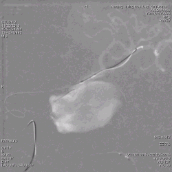 为什么要用到微导管张鑫教授：“球囊锚定微导管辅助到位”技术在Pipeline Flex治疗复杂动脉瘤手术中的应用_https://www.jmylbn.com_新闻资讯_第6张