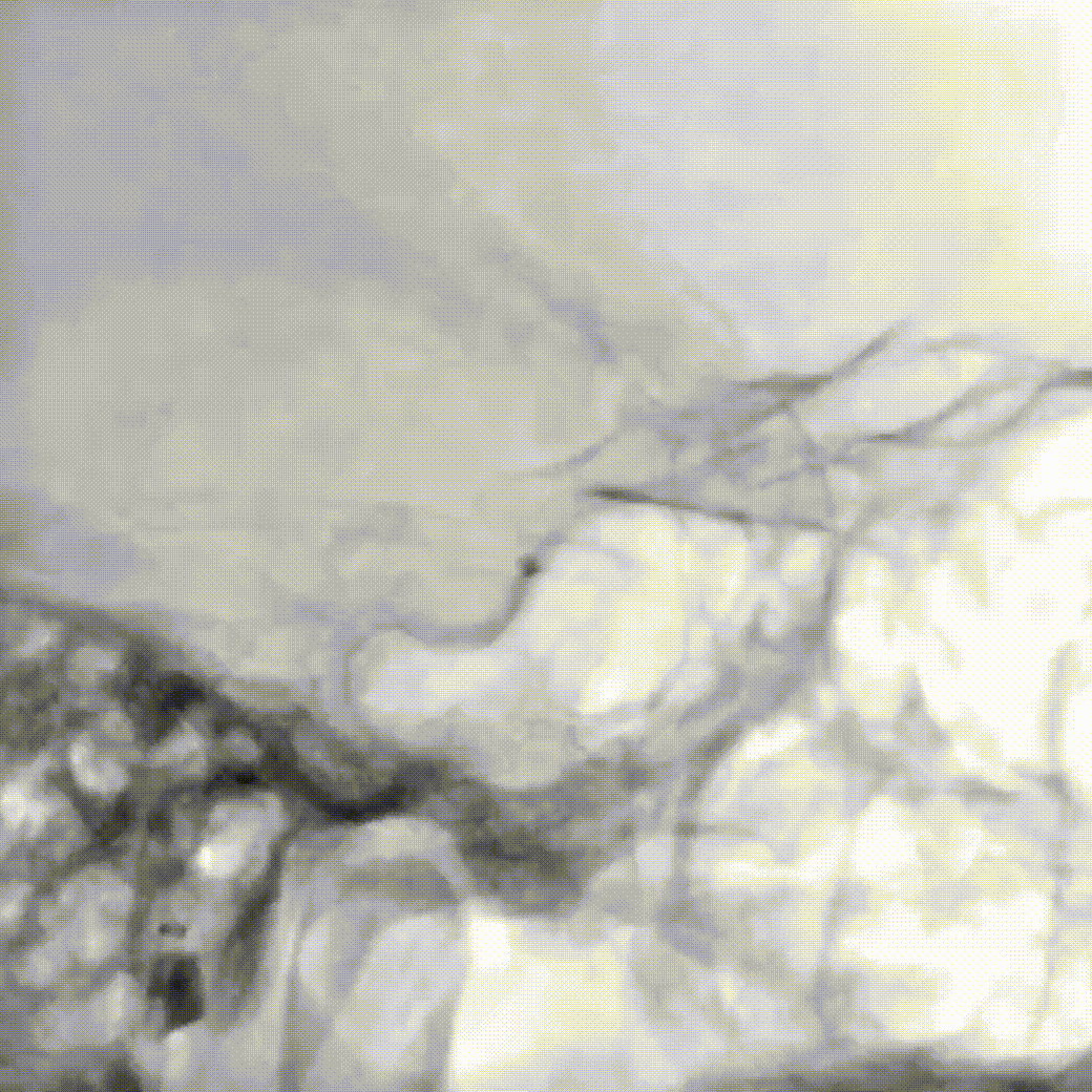 动脉长鞘怎么置入疏堵有道丨8F长鞘辅助BGC球囊导管大脑中动脉取栓术_https://www.jmylbn.com_新闻资讯_第9张