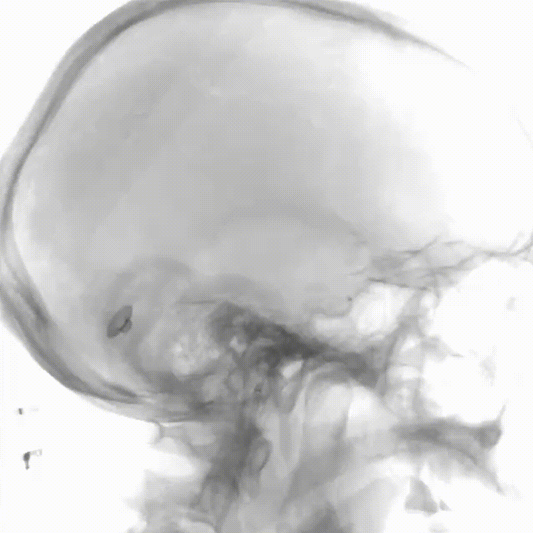 动脉长鞘怎么置入疏堵有道丨8F长鞘辅助BGC球囊导管大脑中动脉取栓术_https://www.jmylbn.com_新闻资讯_第11张