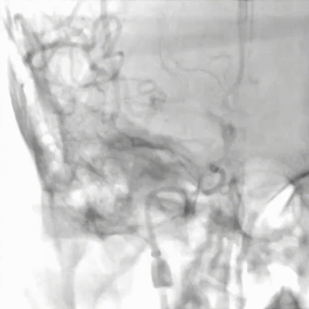动脉长鞘怎么置入疏堵有道丨8F长鞘辅助BGC球囊导管大脑中动脉取栓术_https://www.jmylbn.com_新闻资讯_第8张