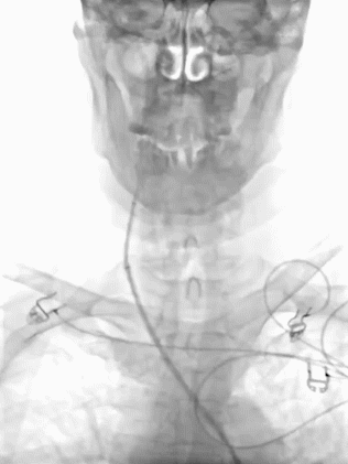 动脉长鞘怎么置入疏堵有道丨8F长鞘辅助BGC球囊导管大脑中动脉取栓术_https://www.jmylbn.com_新闻资讯_第7张
