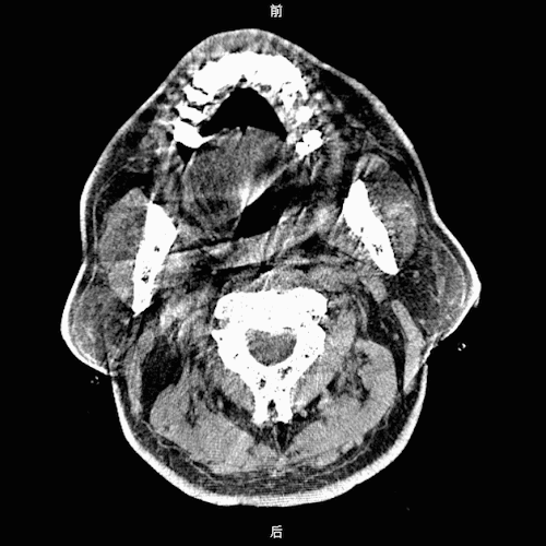 动脉长鞘怎么置入疏堵有道丨8F长鞘辅助BGC球囊导管大脑中动脉取栓术_https://www.jmylbn.com_新闻资讯_第12张