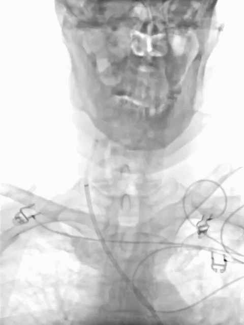 动脉长鞘怎么置入疏堵有道丨8F长鞘辅助BGC球囊导管大脑中动脉取栓术_https://www.jmylbn.com_新闻资讯_第6张