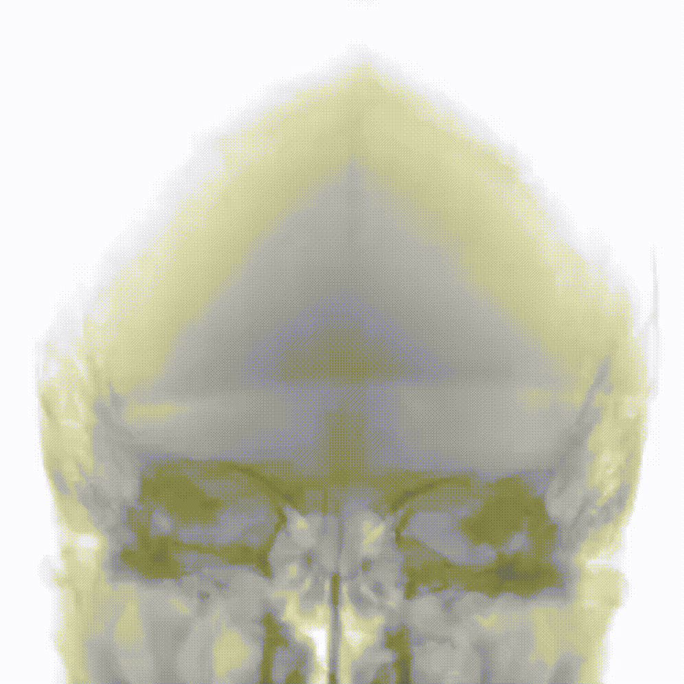 动脉长鞘怎么置入疏堵有道丨8F长鞘辅助BGC球囊导管大脑中动脉取栓术_https://www.jmylbn.com_新闻资讯_第10张