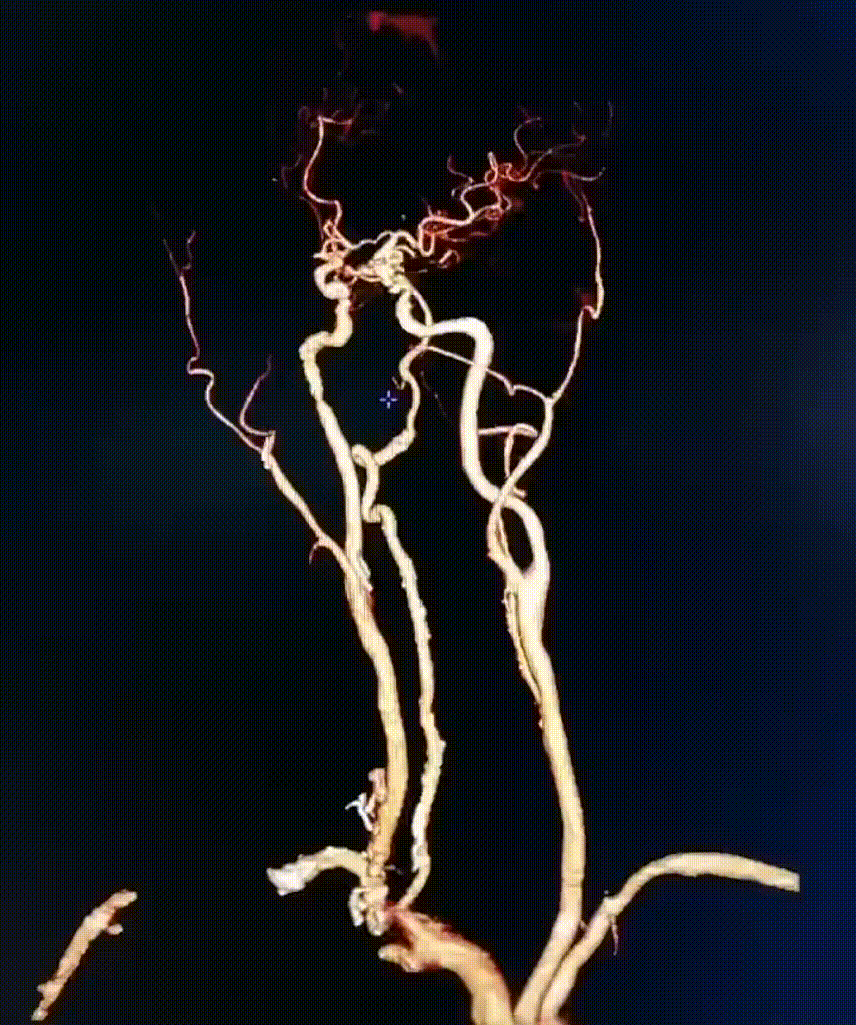 动脉长鞘怎么置入疏堵有道丨8F长鞘辅助BGC球囊导管大脑中动脉取栓术_https://www.jmylbn.com_新闻资讯_第5张