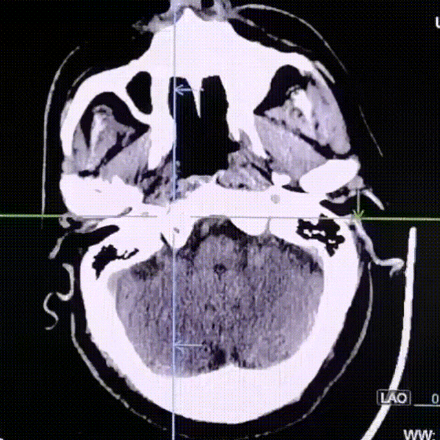 动脉长鞘怎么置入疏堵有道丨8F长鞘辅助BGC球囊导管大脑中动脉取栓术_https://www.jmylbn.com_新闻资讯_第4张
