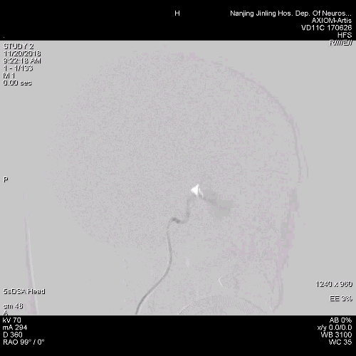 为什么要用到微导管张鑫教授：“球囊锚定微导管辅助到位”技术在Pipeline Flex治疗复杂动脉瘤手术中的应用_https://www.jmylbn.com_新闻资讯_第4张