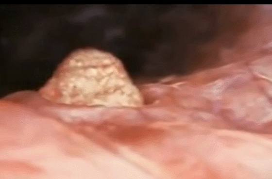 试管婴儿移植后常见症状与对策，都在这儿了~