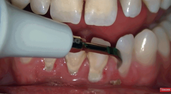 ems洁牙尖怎么分口臭886~市海沧医院开设洁牙门诊_https://www.jmylbn.com_新闻资讯_第6张