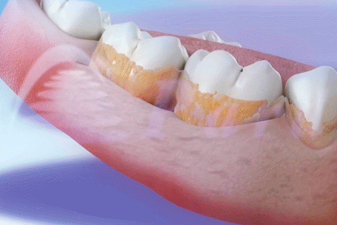 ems洁牙尖怎么分口臭886~市海沧医院开设洁牙门诊_https://www.jmylbn.com_新闻资讯_第8张