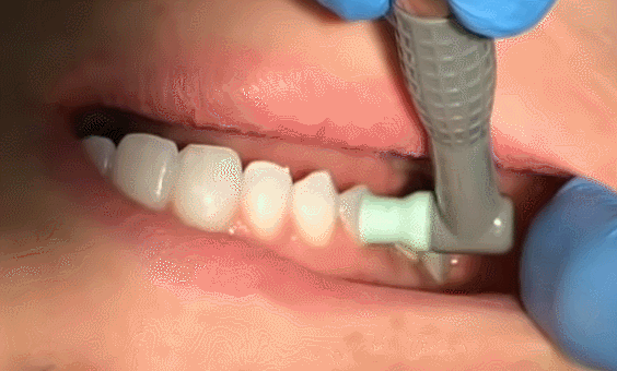 ems洁牙尖怎么分口臭886~市海沧医院开设洁牙门诊_https://www.jmylbn.com_新闻资讯_第10张