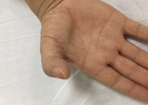 手指疼痛难以伸直？快来看看是不是得了腱鞘炎！