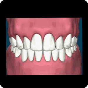 但显著的表现就是牙龈红肿溢脓,牙齿松动移位,牙龈退缩等等