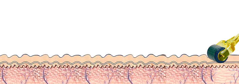 怎么消毒滚针爱美女士必看！这种中医外治疗法，可有效改善肌肤问题_https://www.jmylbn.com_新闻资讯_第5张