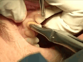 唠一唠拔牙这点事儿~