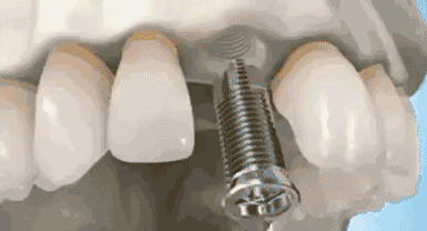 3分钟，带你了解种植牙详细流程！