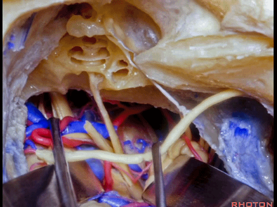 外展枕怎么使用脑干解剖及相关入路---Rhoton解剖视频学习笔记系列_https://www.jmylbn.com_新闻资讯_第286张