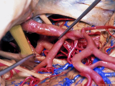 外展枕怎么使用脑干解剖及相关入路---Rhoton解剖视频学习笔记系列_https://www.jmylbn.com_新闻资讯_第200张