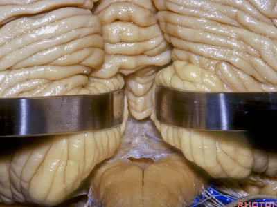 外展枕怎么使用脑干解剖及相关入路---Rhoton解剖视频学习笔记系列_https://www.jmylbn.com_新闻资讯_第233张