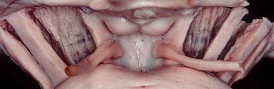 外展枕怎么使用脑干解剖及相关入路---Rhoton解剖视频学习笔记系列_https://www.jmylbn.com_新闻资讯_第51张