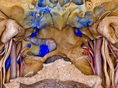 外展枕怎么使用脑干解剖及相关入路---Rhoton解剖视频学习笔记系列_https://www.jmylbn.com_新闻资讯_第335张