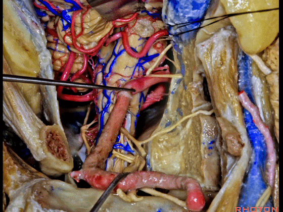 外展枕怎么使用脑干解剖及相关入路---Rhoton解剖视频学习笔记系列_https://www.jmylbn.com_新闻资讯_第323张