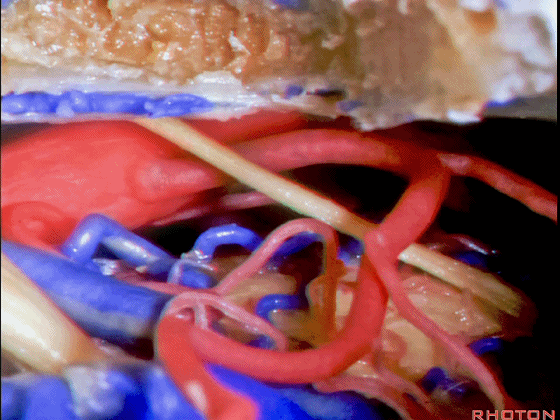 外展枕怎么使用脑干解剖及相关入路---Rhoton解剖视频学习笔记系列_https://www.jmylbn.com_新闻资讯_第291张