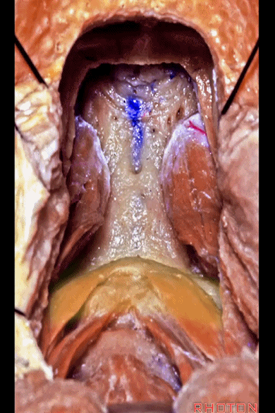 外展枕怎么使用脑干解剖及相关入路---Rhoton解剖视频学习笔记系列_https://www.jmylbn.com_新闻资讯_第313张